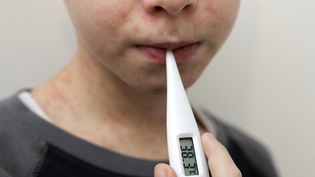 Measles: What You Need to Know